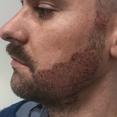 beard-transplant