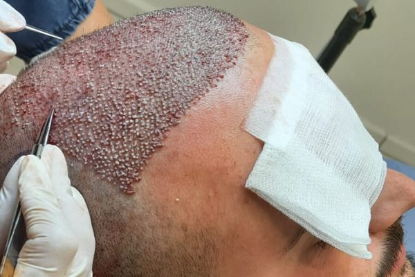 hair-transplant-in-pune
