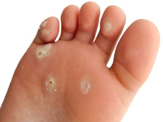 laser-corn-removal-treatment