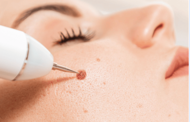 mole-removal-treatment