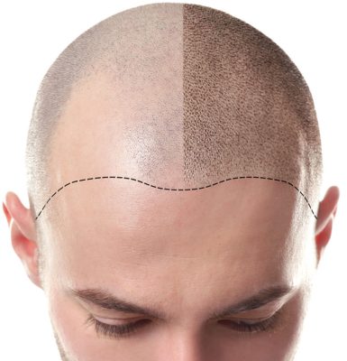 scalp-micropigmentation