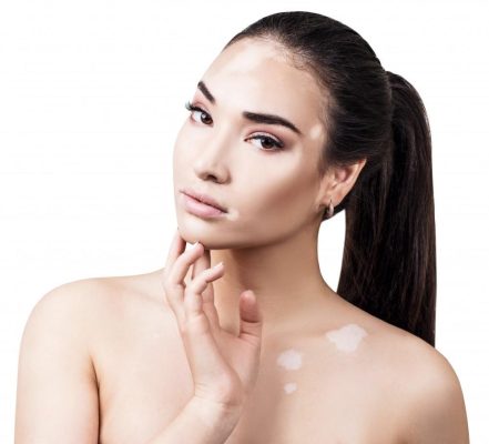 vitiligo-treatment-in-viman-nagar